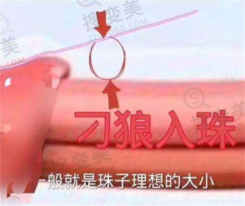 韩国腹壁整形医院排名前十，推荐原辰医院，肚脐切口技术优效果好 