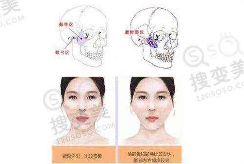 腋臭做手术可以完全有效治疗吗——不同医院手术成效及收费