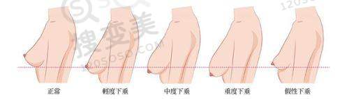想了解男性去势手术？2025年副作用解析
