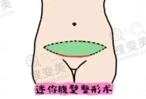 男性去势手术询问网：手术时间大解析