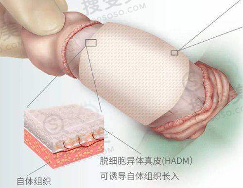 进口三件套假体大概多少钱?——受地区因素影响