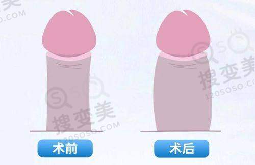 上眼睑下垂更好的治疗方法之隧道式微创悬吊术术后护理与成效