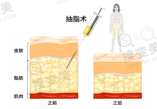 上眼脸下垂是什么原因引起的？填充过多/位置偏下/压迫神经是主因 