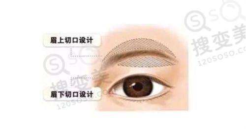上眼脸下垂是什么原因引起的——填充位置偏下