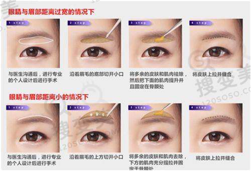 上眼睑下垂手术至佳年龄之儿童中期(2岁半 - 6岁)