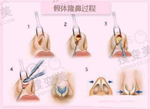 上眼脸下垂是什么原因引起的——疾病因素