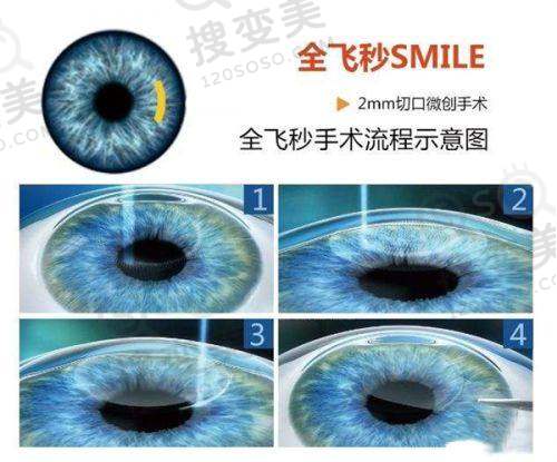 亲历北京茗视光眼科医院全飞秒:周跃华操刀,术后修复的惊喜成效