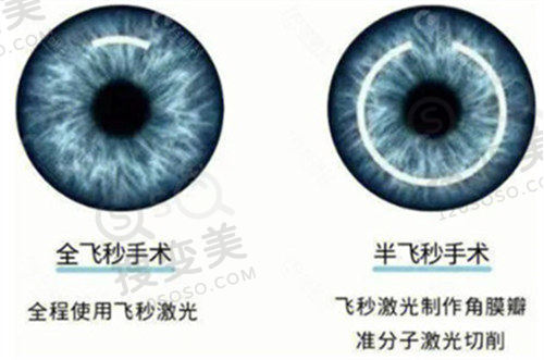 2025杭州白内障手术免费政策:60岁以上老人申请，术后多数视力可达0.8以上 
