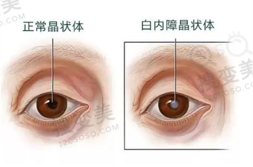 武汉爱尔眼科汉口医院近视手术做的怎么样？技术优医生强，激光8500起性价比高 