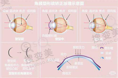武汉爱尔眼科汉口医院近视手术做的怎么样？技术实力彰显优势