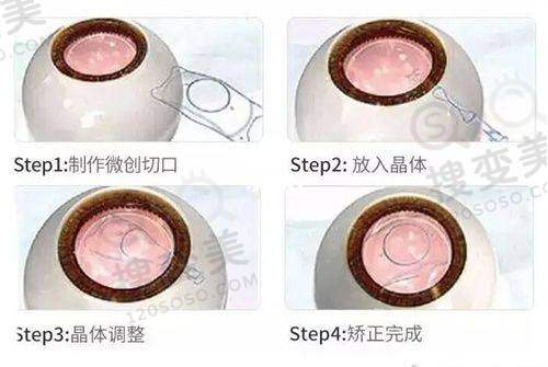 河南省人民医院眼科收费标准：全飞秒14500元起！ICL晶体植入32543 元！——其他眼科手术收费情况