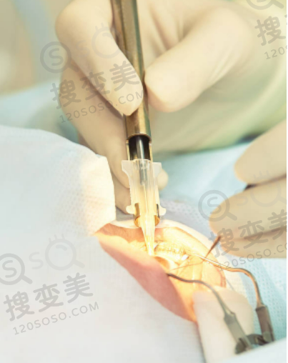 河南省人民医院眼科收费标准：全飞秒14500元起！ICL晶体植入32543 元！——真实患者体验实例