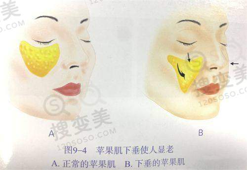 胸部注射胶原蛋白后一直特别硬咋回事?难道手术真有啥后遗症或危害?——吸收不良导致硬结