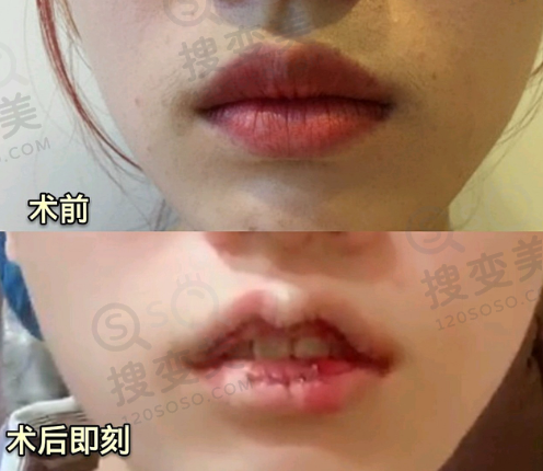 深圳张辉隆鼻避雷?假的!张辉医生价格透明,赫本鼻4万起预约已爆档