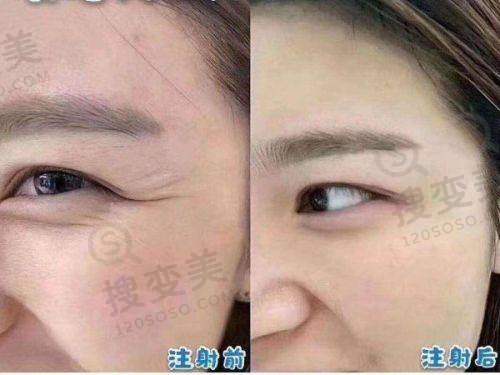 问一下长沙拉皮手术哪里整容医院做的好？——总结与建议