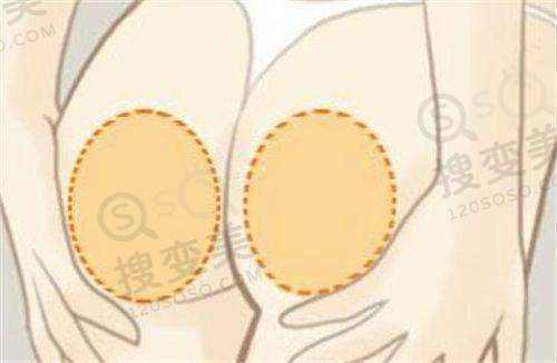 广州华美整形医院好不好?正规吗?真实项目实例公布!——收费价格情况