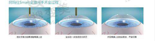 北京眼科具有影响力私立医院排名前三之爱尔英智服务特色