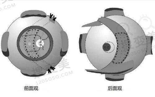 2025昆明胡敏眼科医生价格收费表（飞秒近视手术1.2w+晶体植入术2.8w+老花眼4w）——基础费用及价格波动说明