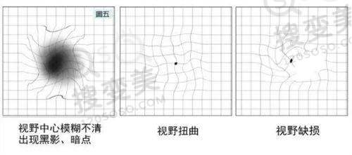2025昆明胡敏眼科医生价格收费表（飞秒近视手术1.2w+晶体植入术2.8w+老花眼4w）——其他热门项目价格