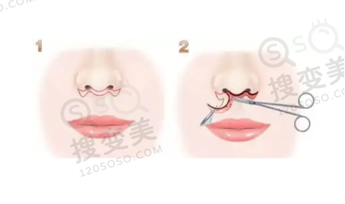 双眼皮修复的十大杰出医生排名公开:都是国内做眼修复有名的医生——朱迪医生