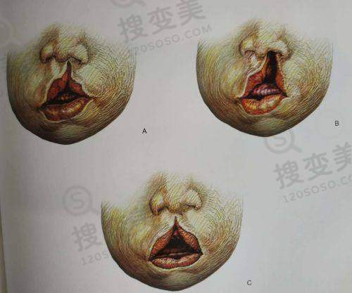 蝴蝶型和馒头型区别在哪——性生活体验差异