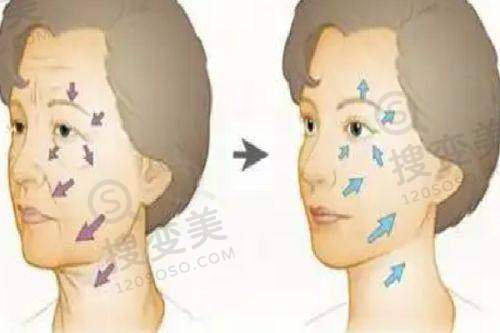 南京鼓楼医院眼科近视手术价格之ICL晶体植入术