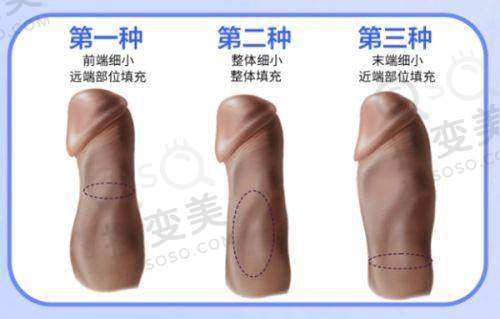 无锡维乐口腔做种植牙可以补贴3000 - 10000元,这是真的吗?——种植牙技术优势