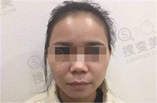南京鼓楼医院眼科近视手术价格之其他相关费用