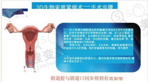 无锡维乐口腔做种植牙可以补贴3000 - 10000元,这是真的吗?——补贴活动详情