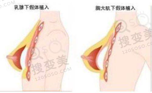 变性手术24小时免费在线问诊:泰国IDL医院特色
