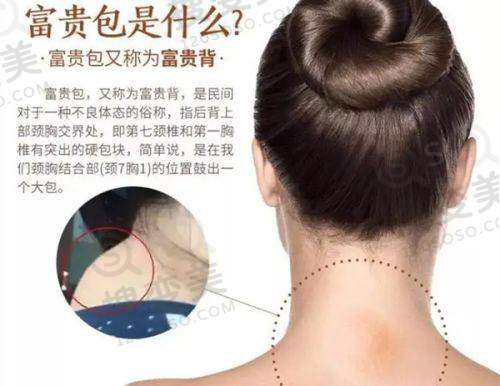 男性注射泰国丰胸针三个月的变化:成效消退与不良反应