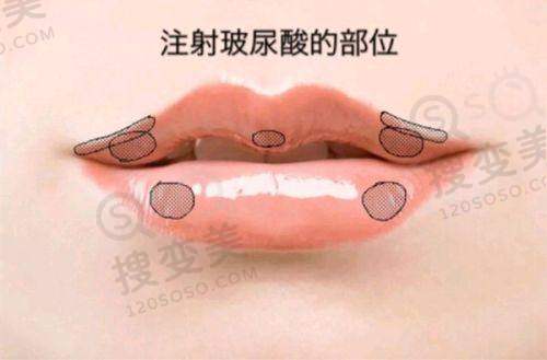 李自力做正颌技术腻害——精细的手术技术