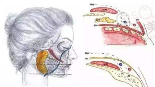 男生假体隆胸要多少钱：不同假体的价格差异
