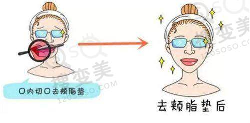 生物补片4x6能增粗多少？其增粗的结果可能在1到2厘米之间——手术前后的注意事项
