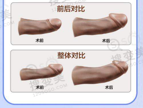 双眼皮做坏找成都林靖修复的人不少,大肉条闭不上眼睛统统成功搞定,这实力无需多言——林靖医生口碑见证