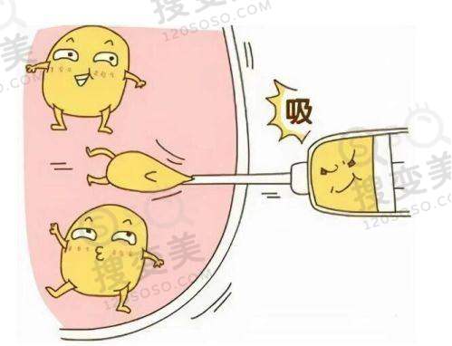 peek材质修复下颌骨好吗？从真人实例看成效