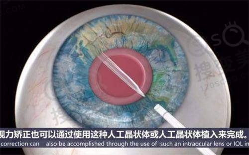 汉口爱尔眼科和武昌爱尔眼科医院有什么区别?都属爱尔眼科集团分院地址不在同一个区——设备与技术差异