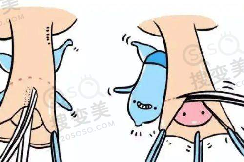 润致5号打完会老得更快吗?不会，填充塑形佳维持12个月效果好 
