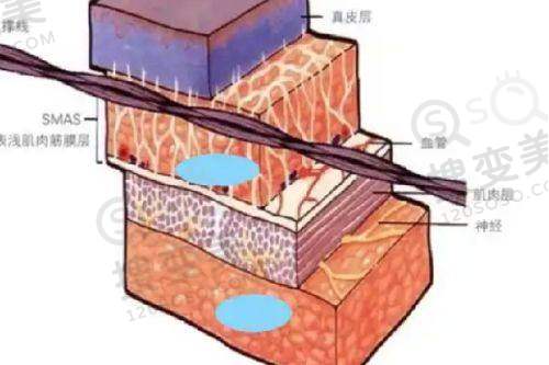 北京面部筋膜提升哪做的好——综合选择建议
