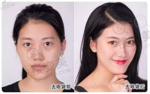 北京面部筋膜提升哪做的好——北京煤医西坝河医疗美容