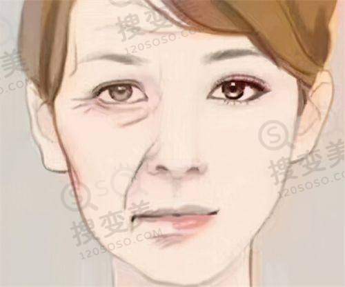 4mg薇旖美打眼部够用吗——注射方式及注意事项