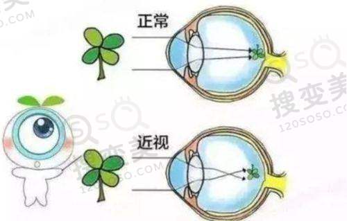 兰州飞秒手术哪家好?兰州飞秒手术前十医生院排名情况推测