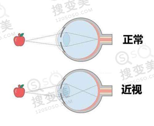 沈晔医生做近视手术怎么样,口碑评价之患者高度认可