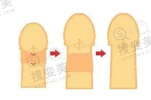 上海华美整形医院假体丰臀项目:价格与技术优势在哪?