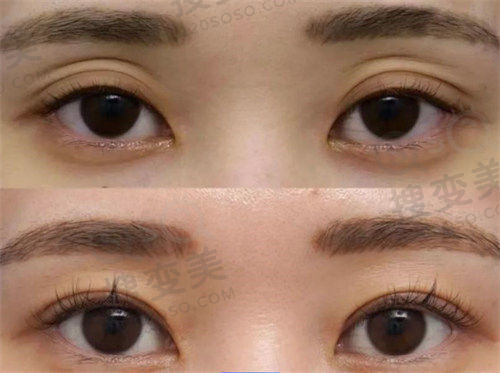长沙假体隆胸哪家好?雅美、亚韩、艺星等医院医生技术优价格合理