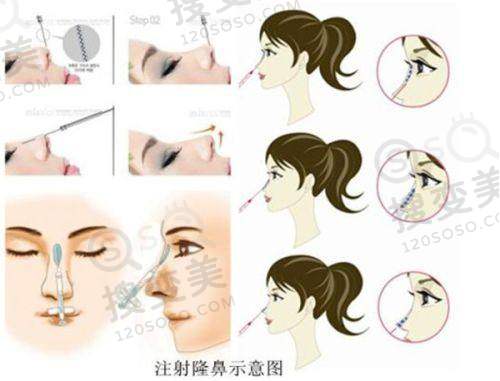 哈尔滨双眼皮修复哪家医院做的好?精选榜单来袭!——价格参考