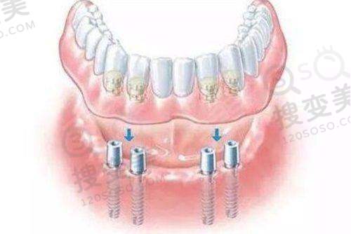 9、杭州钱塘牙科医院真人口碑评价怎么样?
