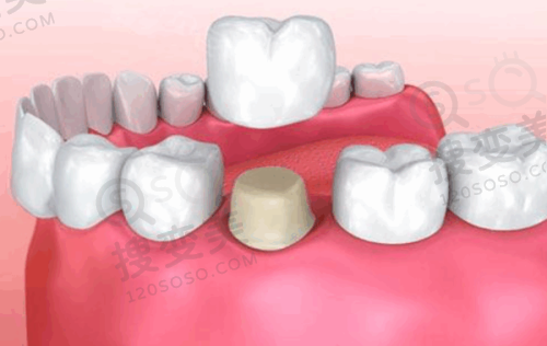 半固定种植牙需要哪些材料?