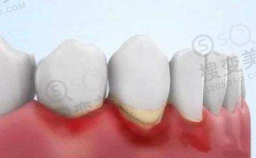 什么叫全固定种植牙?