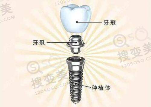 成都英博口腔医院种植牙怎么样？技术硬核，价格亲民，患者口碑好评如潮 